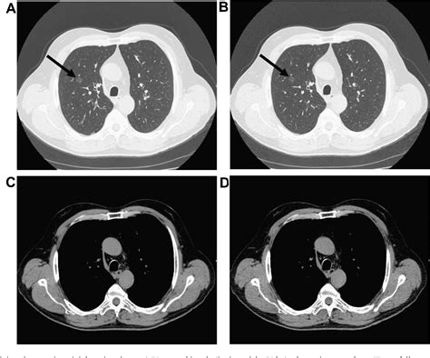 Figure 2 From Low Dose Chest Ct Protocol 50 Mas As A Routine Protocol