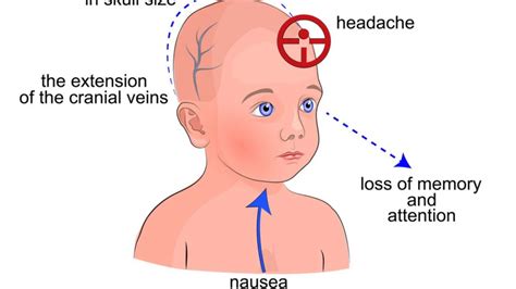 Par Lisis Cerebral Infantil Causas Y C Mo Se Puede Prevenir