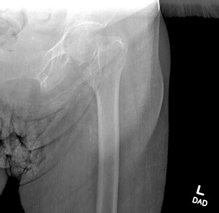 Femoral Subcapital Neck Fracture Radiology Case Radiopaedia Org