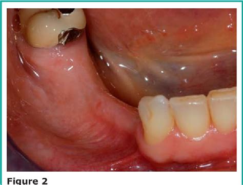 Figure From Piezoelectric Surgery In Mandibular Split Crest Technique