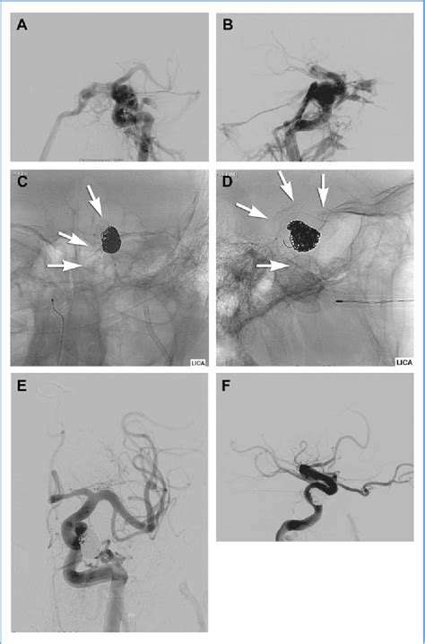 Figure 4 From The Evolution Of Endovascular Treatment Of Carotid Cavernous Fistulas A Single