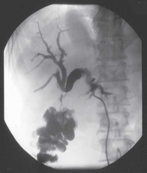 Cholangiogram Demonstrating Obstruction At The Confluence Of The Right