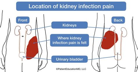 Kidney infection symptoms - PatientEducationMD