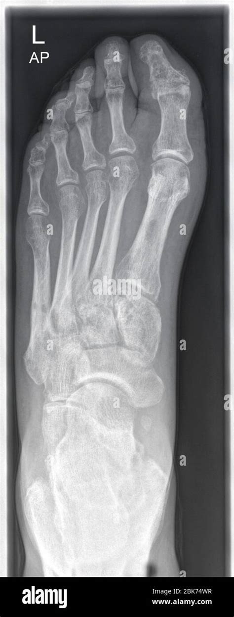 Radiograph X Ray Image Of A Human Left Foot Stock Photo Alamy