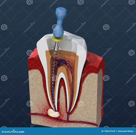 Root Canal Treatment Process Illustration Stock Illustration