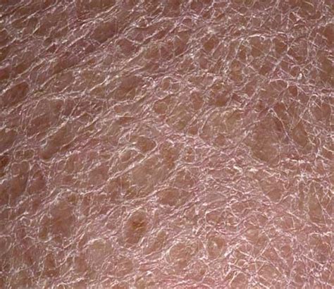 Scaly Skin On Leg Pictures Photos