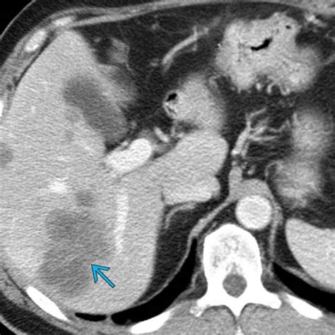 Duodenal Carcinoma | Radiology Key