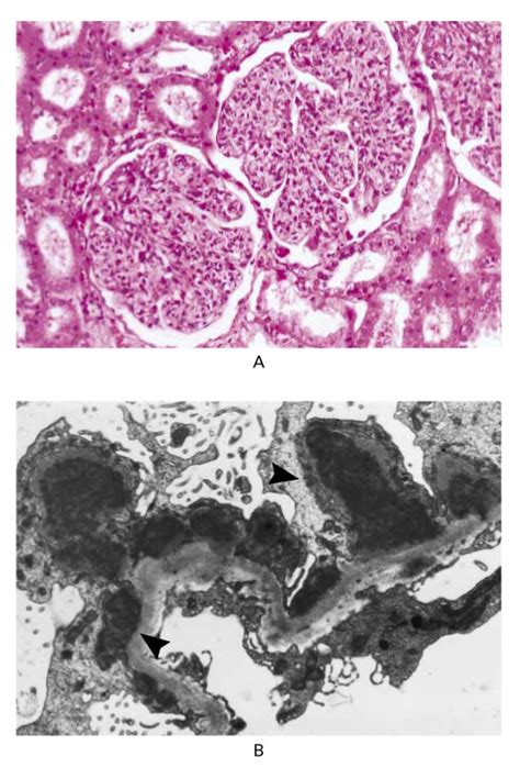 Glomerulonephritis New England Journal Of Medicine