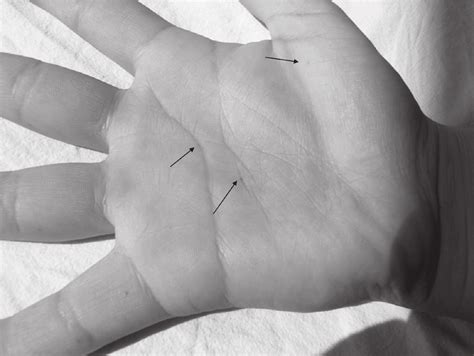 Note The Palmar Pits On The Right Hand Shown By The Black Arrows