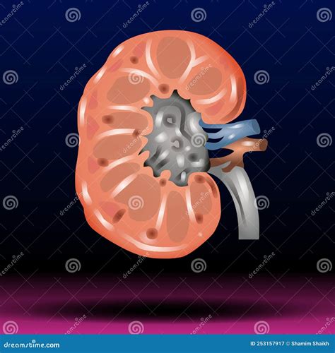 Kidney Internal Organ Kidney Stones Renal Calculi Nephrolithiasis