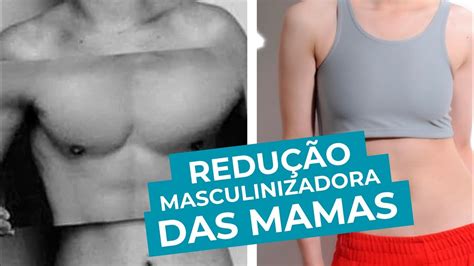 REDUÇÃO MASCULINIZADORA DAS MAMAS CIRURGIÃO PLÁSTICO DR LECY EXPLICA