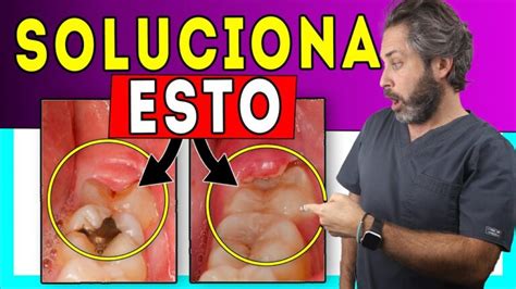 Guía completa para tratar la inflamación de la encía de la muela