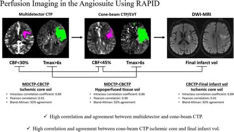 Stroke Aha Asa On Twitter Researchletter Angiography Suite Cone