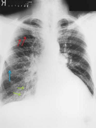 Kerley B Lines Cxr : Septal lines in lung | Radiology Reference Article ...