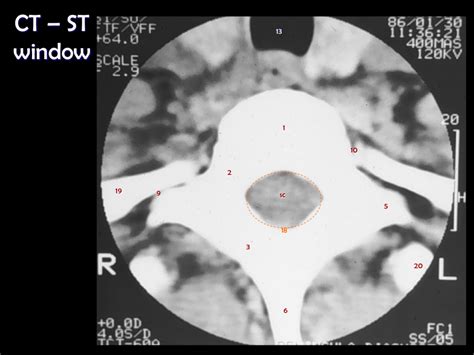 CT Soft Tissue Window Thoracic Spine Diagram Quizlet