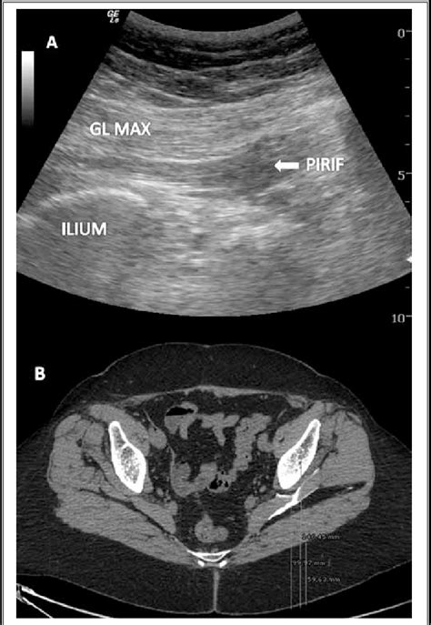 A Ultrasonographic Image Of The Piriformis Muscle In The Longitudinal