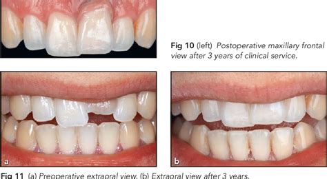 Figure 1 From Minimally Invasive Treatment Of An Ankylosed Severely Discolored And Intruded