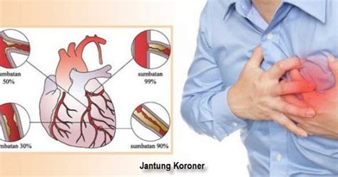 Tuliskan Salah Satu Gangguan Kesehatan Pada Jantung Beserta Cara