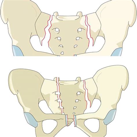 Sacral C2 Fracture C2 Fractures Indicate Bilateral Vertical Fractures Download Scientific