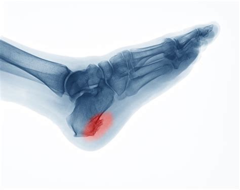 Heel Spur Syndrome | Diagnosis and Treatment