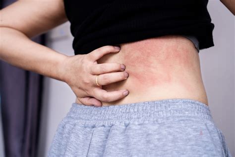 Don’t Let a Rash Ruin Your Day - Urgent Care Rash Treatment in Falls