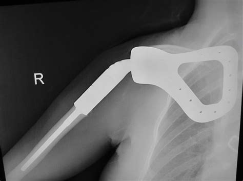 Total Scapula Prosthetic Replacement