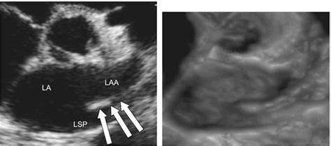 Figure 3 From Coumadin Ridge In The Left Atrium Demonstrated On Three