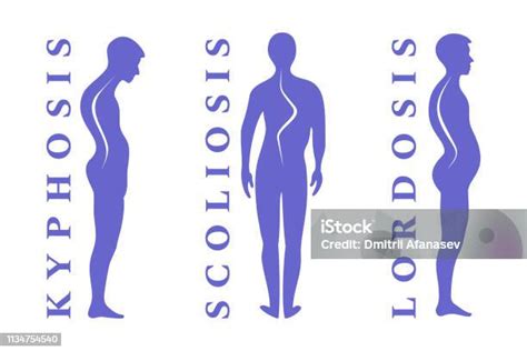 Penyakit Tulang Belakang Skoliosis Lordosis Kyphosis Cacat Postur Tubuh