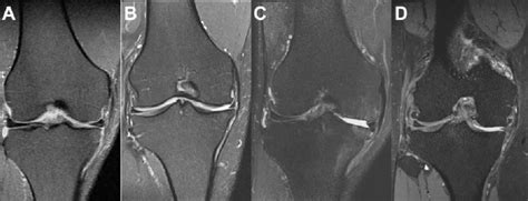 Mri Osteoarthritis Knee Score Moaks Grade Of Osteophytes In The Download Scientific Diagram