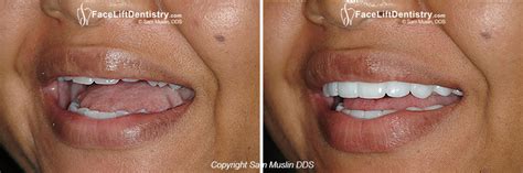 Deep Overbite Correction Without Surgery - New VENLAY ® Restoration ...