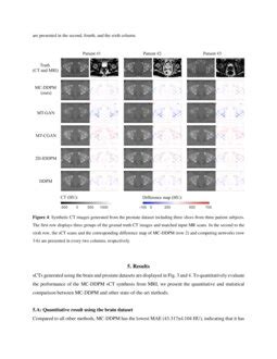 Synthetic CT Generation From MRI Using 3D Transformer Based Denoising