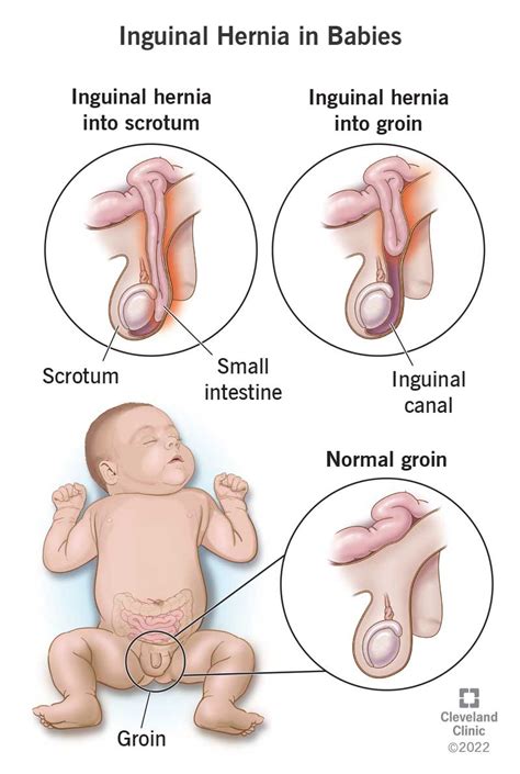 Umbilical Hernia In Babies Umbilical Hernia Hernia Symptoms Low Hot