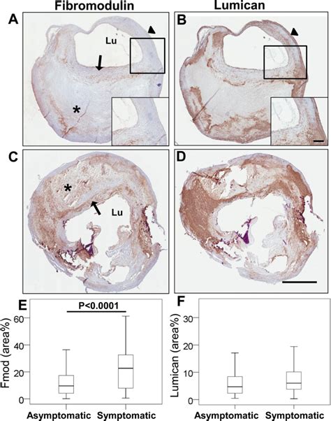 Figure 1 From Expression Of Fibromodulin In Carotid Atherosclerotic