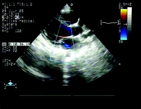 Rheumatic Heart Disease Screening By Echocardiography Circulation