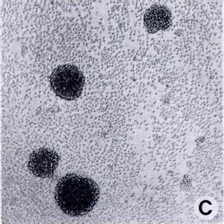 Phase Photomicro Graph Of B Cu Cells In Culture Patient No 5