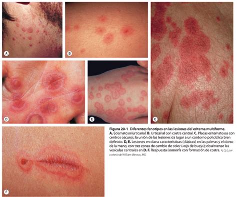 Eritema Multiforme Quizlet