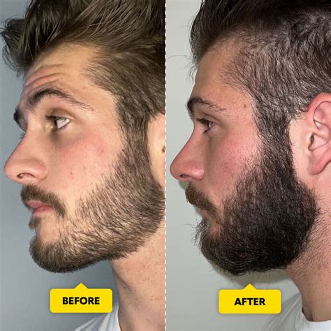 Do Beard Rollers Work Derma Roller Before And After The Beard Club