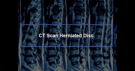 Ct Scan Herniated Disc Dr Kevin Pauza The Discseel® Procedure Inventor