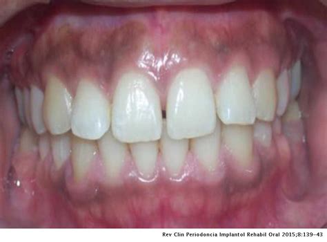 Tratamiento De La Melanosis Gingival Y Evaluación De La Repigmentación