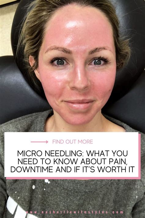 Micro Needling Experience Artofit