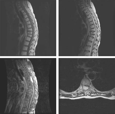 Figure 2 From Spinal Epidural Cavernous Angiomas Angiomas Cavernosos