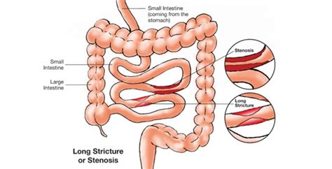 SURGERY FOR A BLOCKAGE OR STRICTURE - Nutrition 4 IBD