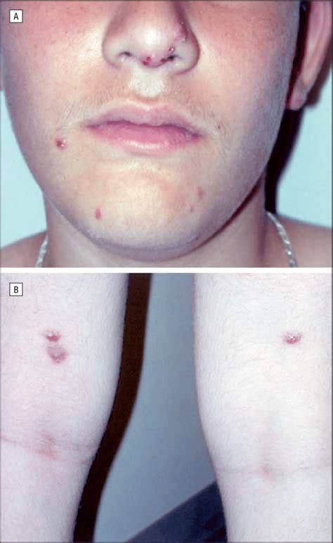 Erythematous And Violaceous Papules With Evidence Of Central Necrosis