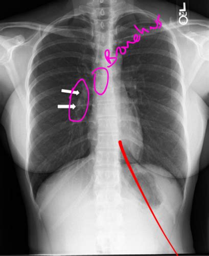 Dx Imaging Normal Chest Anatomy And Pathology Ignore Markings On