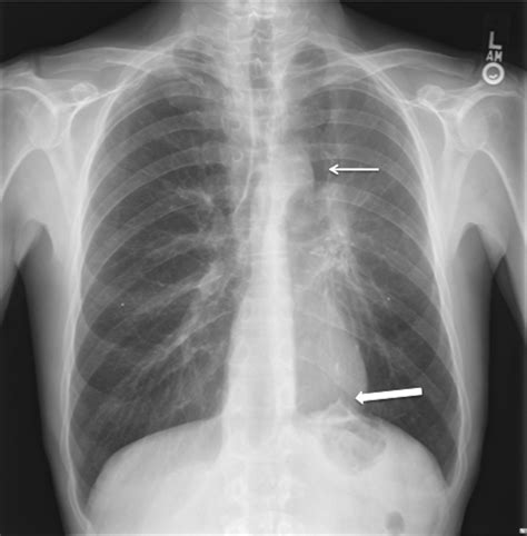 Luftsichel Sign And Juxtaphrenic Peak Sign Bmj Case Reports