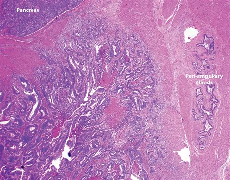 Neoplasms Of The Small Intestine Clinical Tree