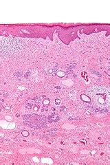 Trichoblastoma - Libre Pathology