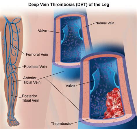 Deep vein thrombosis : Therapeutic dilemmas | Dr.S.Venkatesan MD