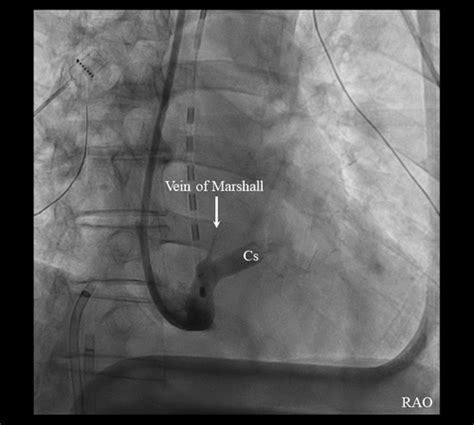 Coronary Arterial Vasospasm A Rare Complication Of Vein Of Marshall