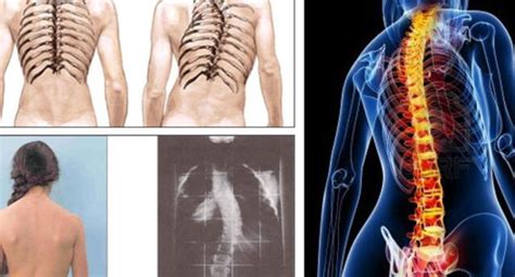 Salud Estos Son Los Signos De Alerta De La Escoliosis El Popular